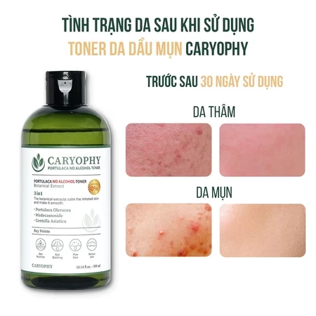 Toner da dầu mụn Caryophy Portulaca Hàn Quốc cấp ẩm ngừa mụn không cồn 300ml